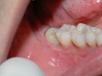 Chirurgia Orale studio odontoiatrico fiumara
