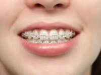 Ortodonzia tradizionale e invisalign studio odontoiatrico fiumara