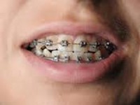 Ortodonzia tradizionale e invisalign