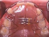Ortodonzia tradizionale e invisalign