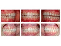 Ortodonzia tradizionale e invisalign