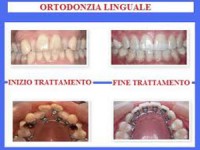 Ortodonzia tradizionale e invisalign