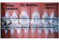 Ortodonzia tradizionale e invisalign