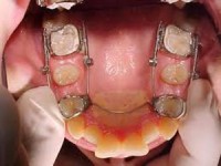 Ortodonzia tradizionale e invisalign