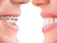 Ortodonzia tradizionale e invisalign