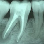 endodonzia chirurgica studio odontoiatrico fiumara