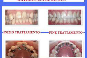 ortodonzia linguale studio odontoiatrico fiumara