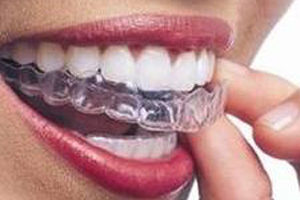 ortodonzia invisalign studio odontoiatrico fiumara