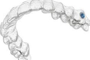 ortodonzia invisalign studio odontoiatrico fiumara