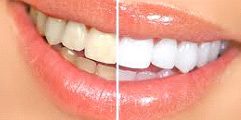 Igiene e sbiancamento igiene dentale e sbiancamento