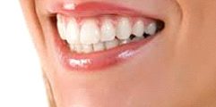 Igiene e sbiancamento igiene dentale e sbiancamento