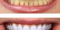 Igiene e sbiancamento laser igiene dentale e sbiancamento laser