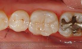 Odontoiatria conservatrice odontoiatria conservatrice studio odontoiatrico fiumara