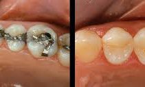 Odontoiatria conservatrice odontoiatria conservatrice studio odontoiatrico fiumara