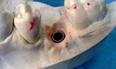 Implantologia implantologia studio odontoiatrico fiumara
