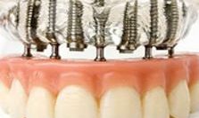 Implantologia implantologia studio odontoiatrico fiumara