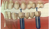 Implantologia implantologia studio odontoiatrico fiumara