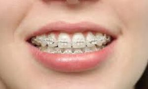 Ortodonzia tradizionale e Invisalign ortodonzia studio odontoiatrico fiumara