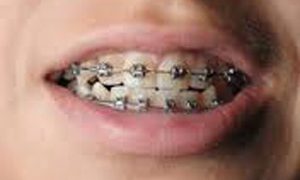 Ortodonzia tradizionale e Invisalign ortodonzia studio odontoiatrico fiumara