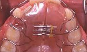 Ortodonzia tradizionale e Invisalign ortodonzia studio odontoiatrico fiumara