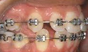 Ortodonzia tradizionale e Invisalign ortodonzia studio odontoiatrico fiumara