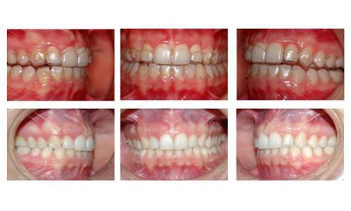 Ortodonzia tradizionale e Invisalign ortodonzia studio odontoiatrico fiumara