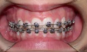 Ortodonzia tradizionale e Invisalign ortodonzia studio odontoiatrico fiumara