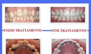 Ortodonzia tradizionale e Invisalign ortodonzia linguale studio odontoiatrico fiumara