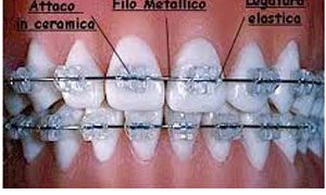 Ortodonzia tradizionale e Invisalign ortodonzia studio odontoiatrico fiumara