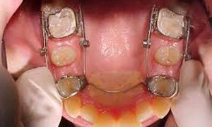 Ortodonzia tradizionale e Invisalign ortodonzia studio odontoiatrico fiumara