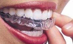 Ortodonzia tradizionale e Invisalign ortodonzia invisalign studio odontoiatrico fiumara