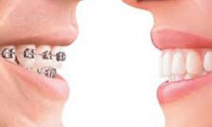 Ortodonzia tradizionale e Invisalign ortodonzia studio odontoiatrico fiumara