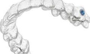 Ortodonzia tradizionale e Invisalign ortodonzia invisalign studio odontoiatrico fiumara