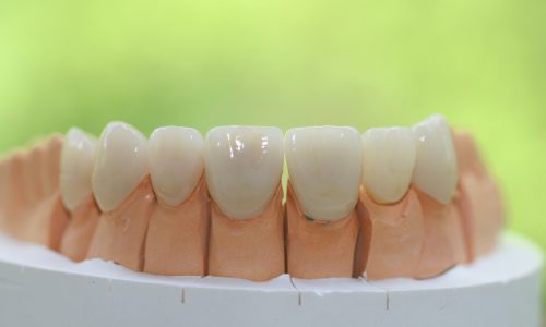 Protesi fissa protesi fissa studio odontoiatrico fiumara
