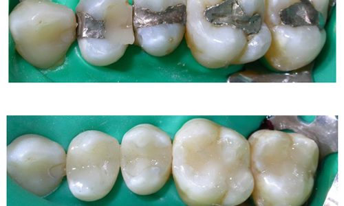 Rimozione amalgama dentale rimozione amalgama dentale studio odontoiatrico fiumara